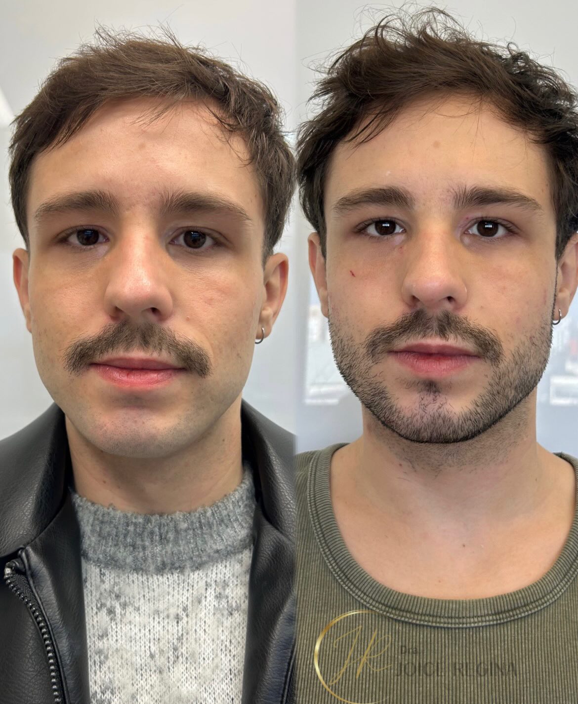 Antes e depois de Harmonização de Perfil Masculino pela Dra. Joice Regina