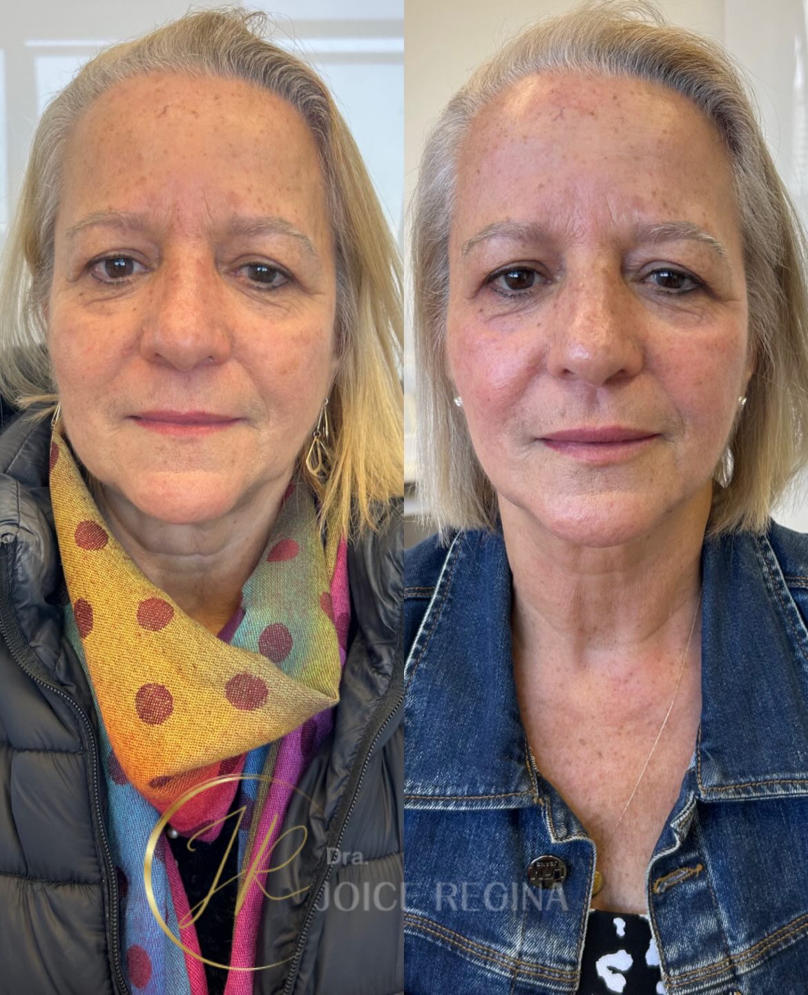 Antes e depois de Rejuvenescimento Facial pela Dra. Joice Regina