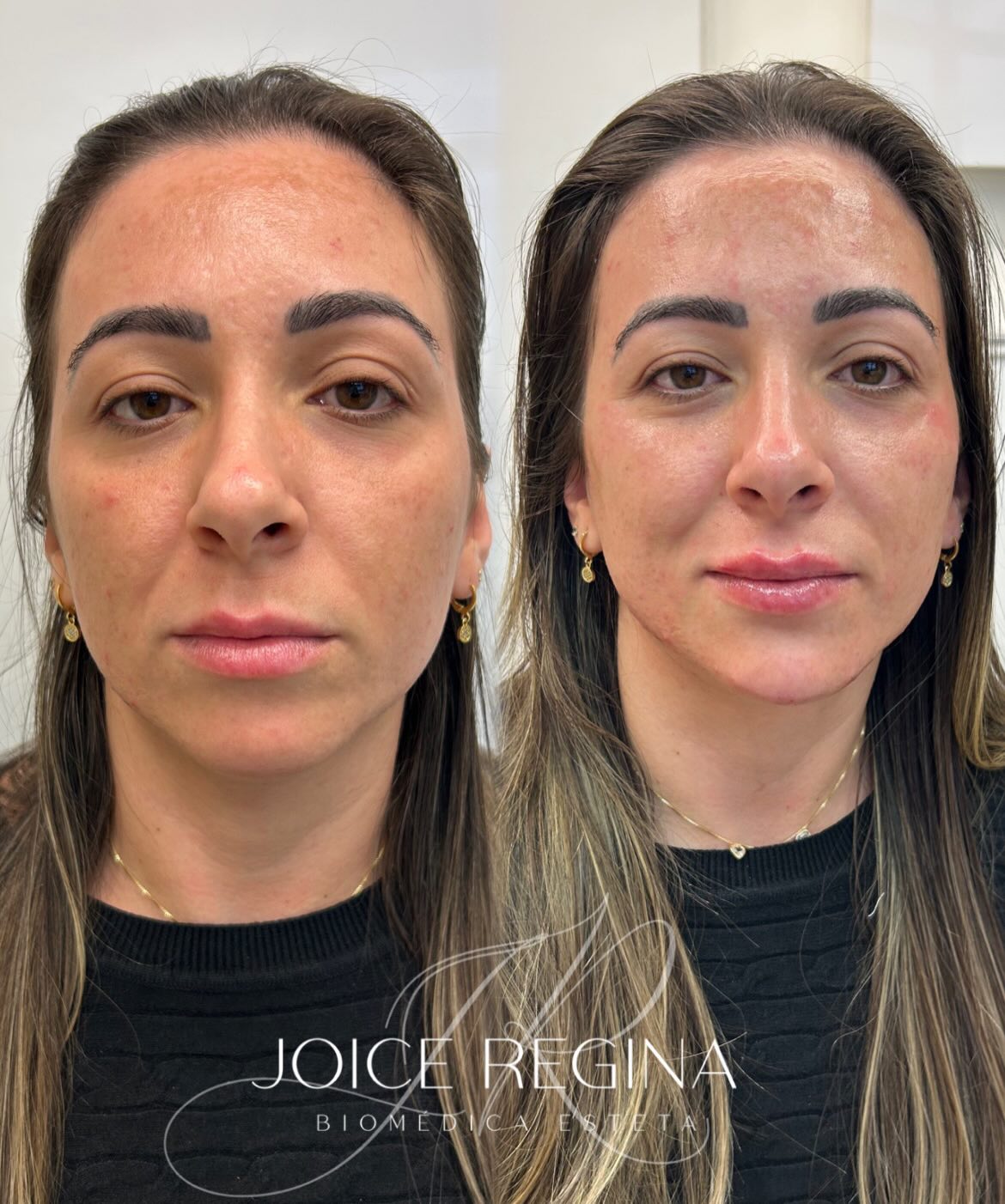 Antes e depois de Preenchimento Full Face pela Dra. Joice Regina