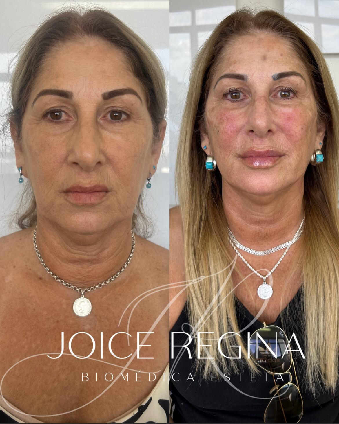 Antes e depois de Tratamento de Sustentação pela Dra. Joice Regina