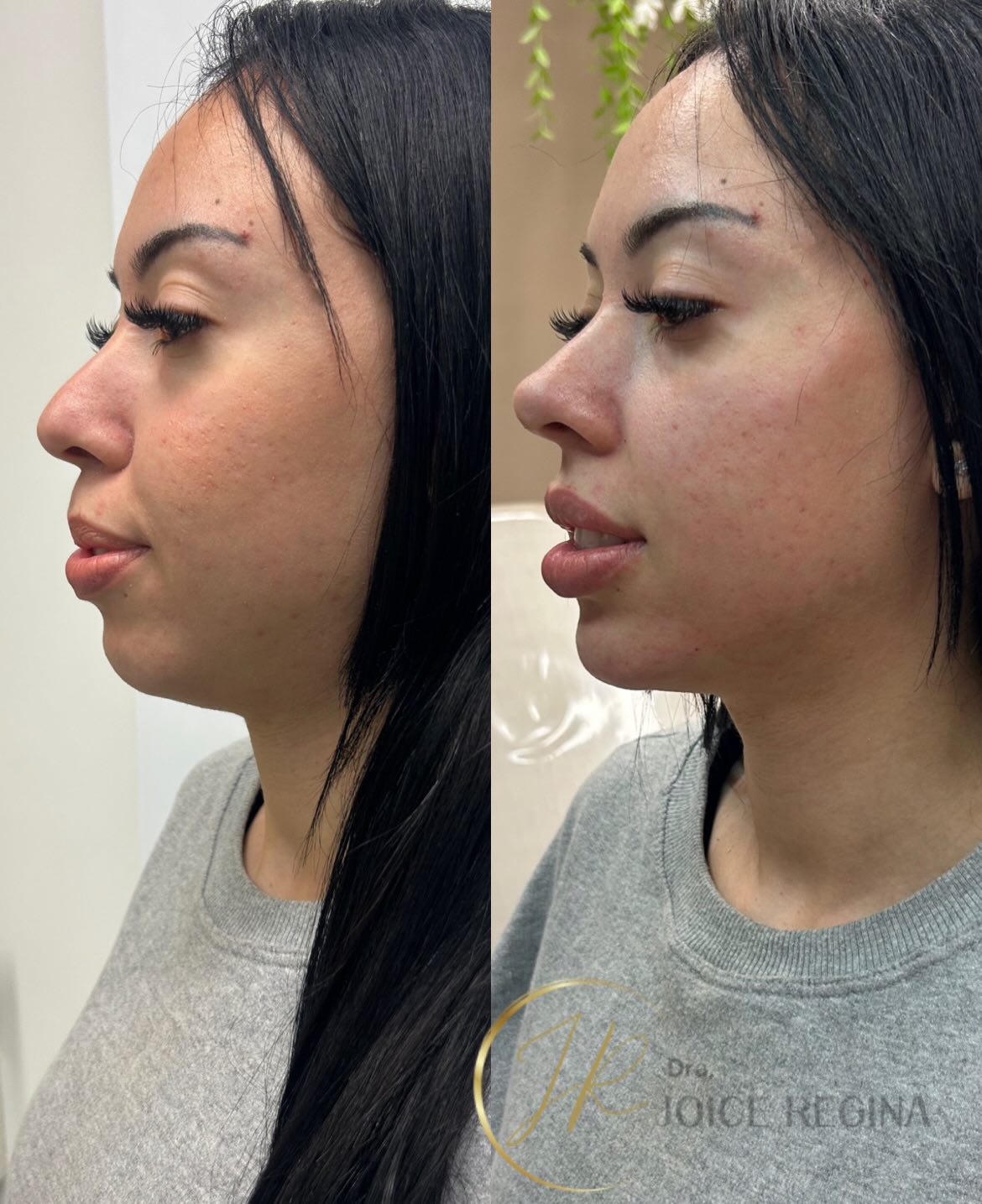 Antes e depois de Rinomodelação e Perfil pela Dra. Joice Regina