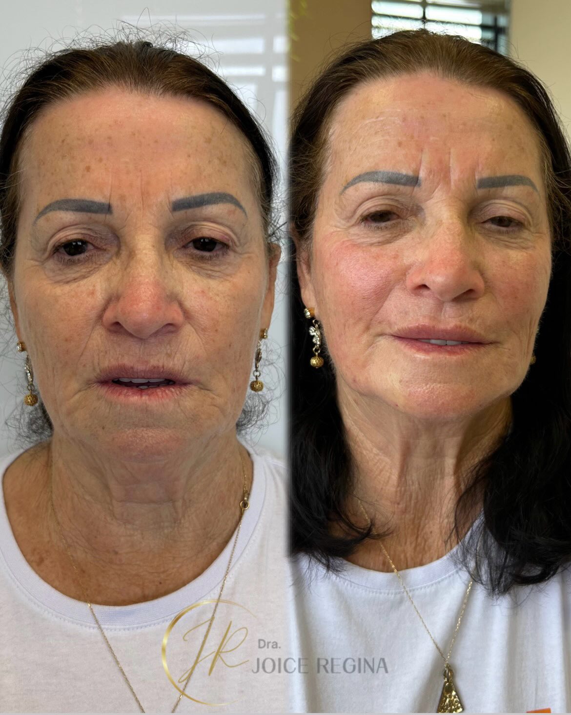 Antes e depois de Restauração Facial pela Dra. Joice Regina